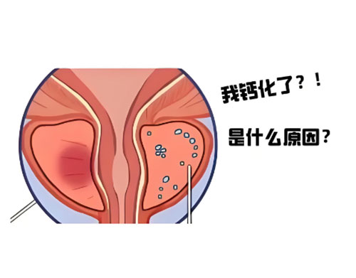 前列腺钙化怎么消失