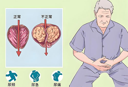 前列腺钙化怎么引起的