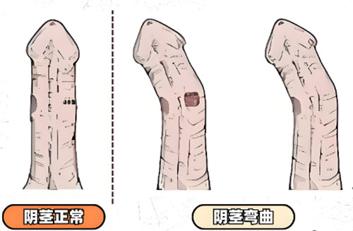 丁丁向上弯曲正常吗