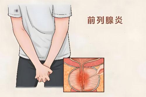 前列腺炎怎么治疗才能彻底好转
