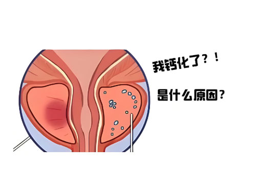 前列腺钙化怎么治疗有什么影响