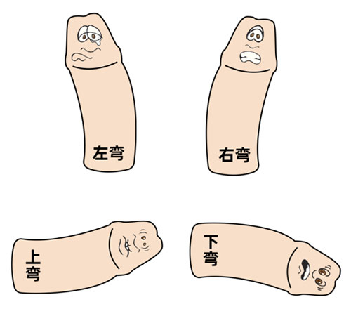 勃起向上弯曲怎么治