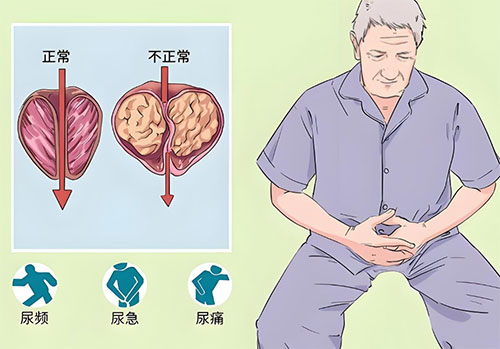 前列腺钙化灶形成是什么意思