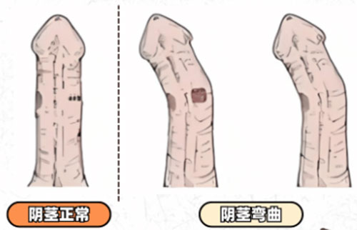 丁丁向左弯怎么回事
