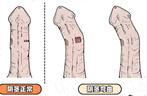 丁丁向左偏斜正常吗