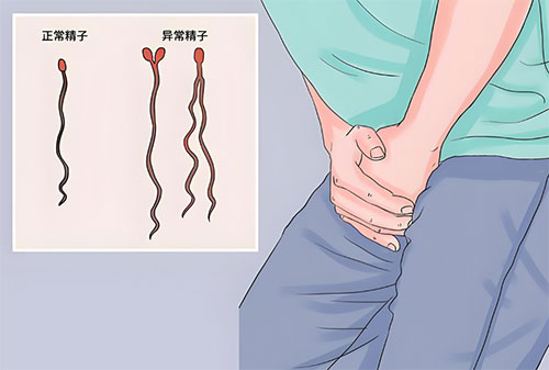 畸形精症怎么治疗