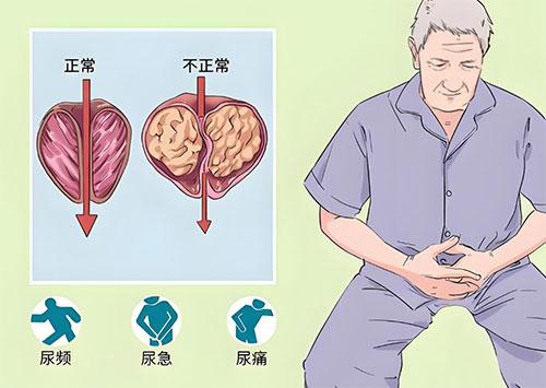 前列腺钙化能治好吗