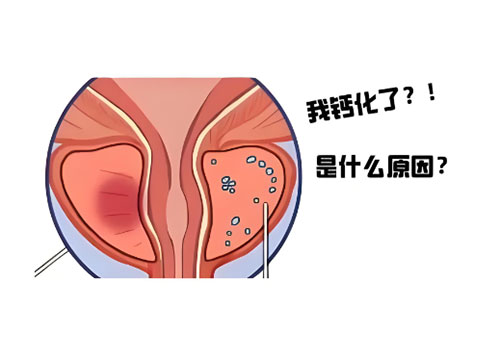 前列腺钙化灶会消失吗