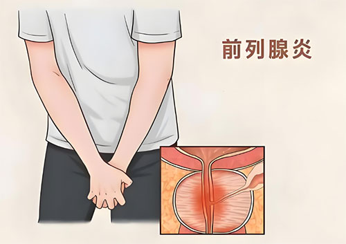 前列腺炎可以自愈吗