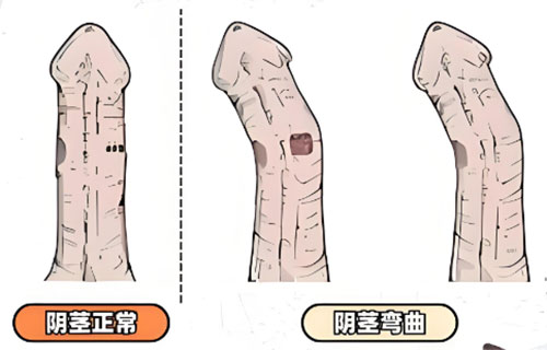 小弟弯曲不手术能矫正吗