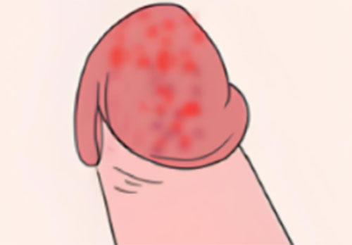 龟头上长了红斑是怎么治疗