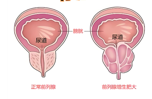 前列腺增生要长期吃药吗