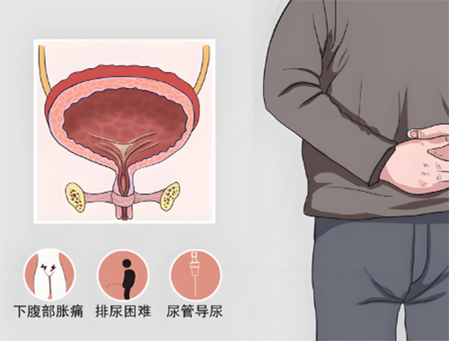 男人尿潴留能治好吗