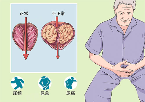 前列腺钙化灶能治愈吗