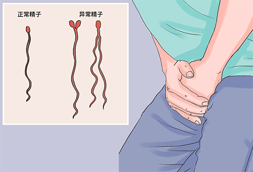 畸形精症是弱精吗
