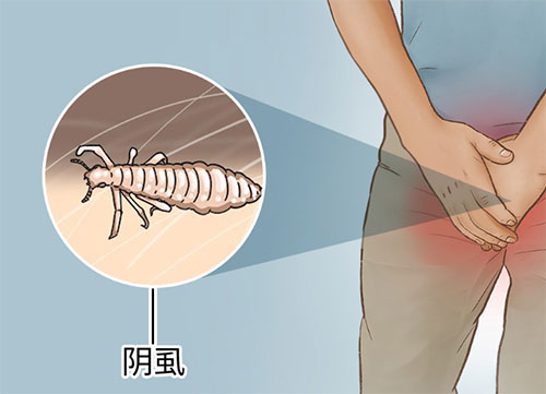 男人阴虱怎么传染的